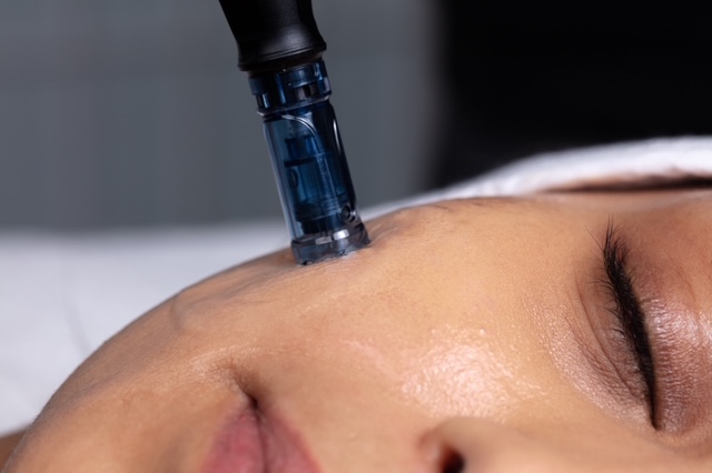 Micro-needling Image